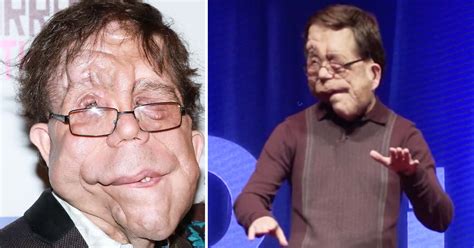 adam pearson als kind|adam pearson actor.